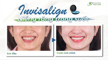 Trải Nghiệm Niềng Răng Tuyệt Vời Với Máng Niềng Trong Suốt Invisalign