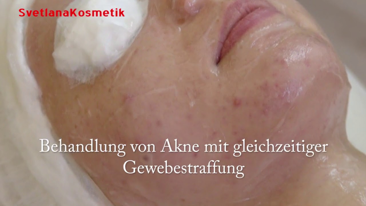 IPL - SHR Super permanent Hair Removal Technologie dauerhafte Haarentfernung Лазернаая эпиляция