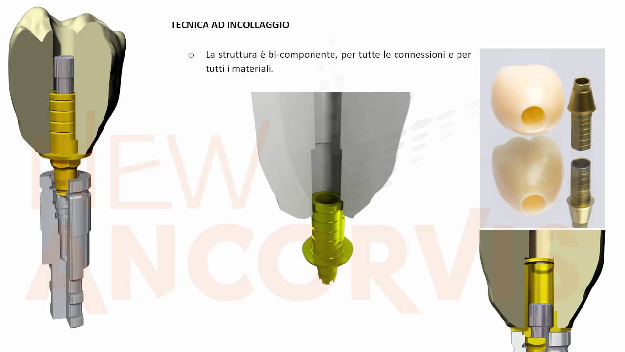 000 11 Tecnica Avvitata o Incollaggio