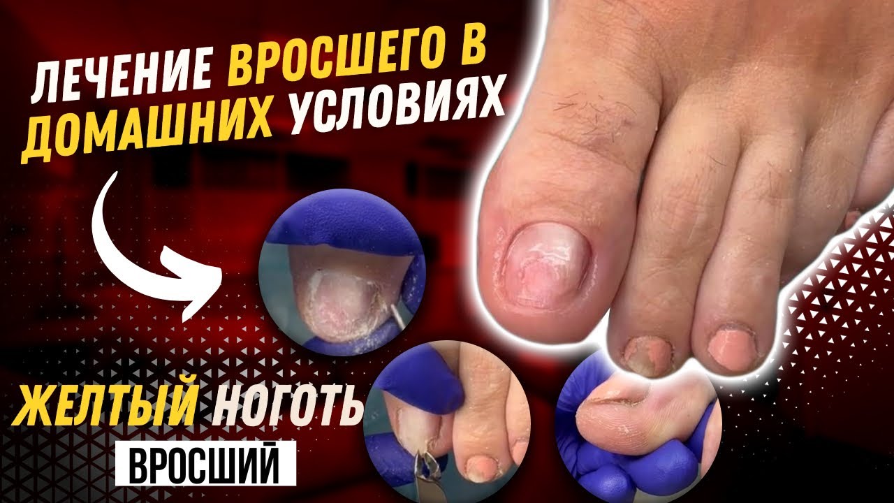 Желтый ноготь / Вросший / Лечение вросшего в домашних условиях #вросший ...