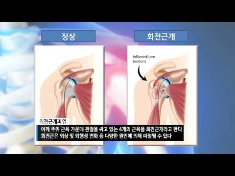 [기획취재] 어깨 통증, 오십견과 회전근개파열