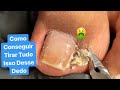 COMO CONSEGUIR TIRAR TUDO ISSO DESSE DEDO🤮  tbt Nail transformation