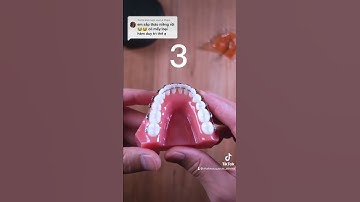 Có mấy loại hàm duy trì sau tháo niềng?
