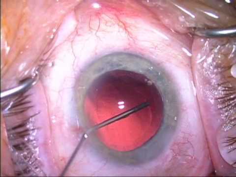 Crystalens Cataract surgery by Steven G. Safran MD