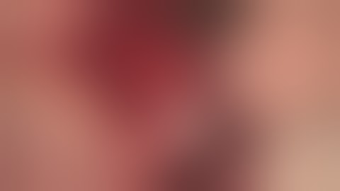 Simple 3 D ridge augmentation using SANTA and Sinus augmentation without bone grafting