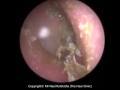 215 - Dead INFECTED Skin, Ear Wax and Fluid Removed off Eardrum - Mr Neel Raithatha (THC)