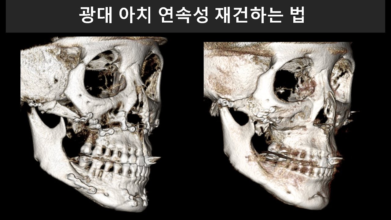 광대 아치 연속성 재건하는 법 (Zygomatic Arch Continuity Reconstruction | Advanced Facial Bone Surgery)