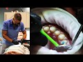 Full Mouth Dental Restoration - LIVE Treatment - Part II