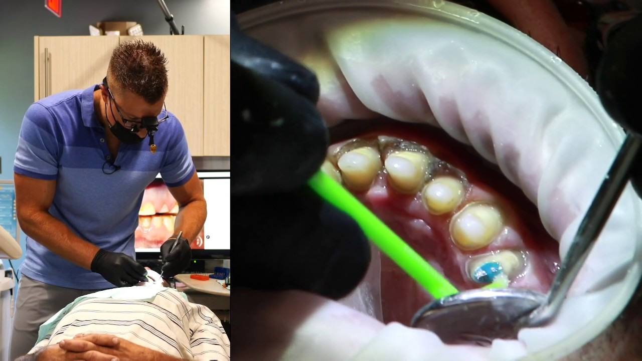 Full Mouth Dental Restoration LIVE Treatment Part II YouTube
