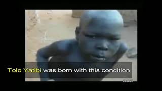 6 Year Old Boy Born With Extra Limbs Abandoned By His Family   Tolo Yatibi