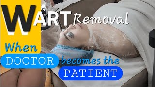 Laser Vs Cautery? My Personal Experience On Wart Removal