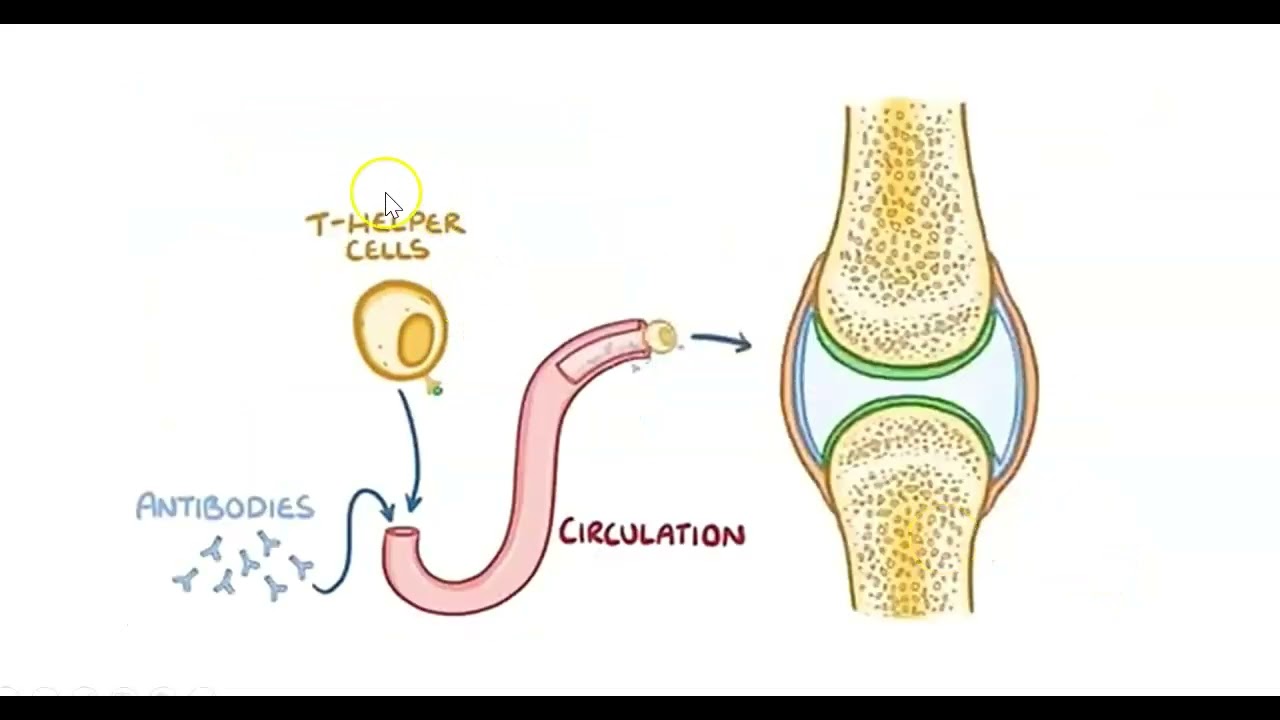 FSPTA 2022. FISIOPATOLOGIA DE LA ARTRITIS REUMATOIDEA