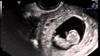 20140120 Ultrasound-2