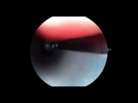 Seg-WAY EGR Procedure Demo