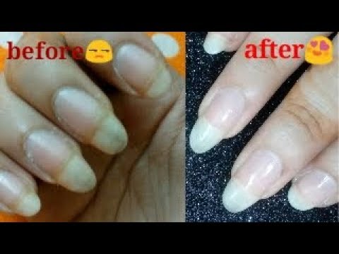 Home remedy to get rid of yellow / discolored nails 💯 guarantee - YouTube
