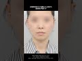 効果のないミニ切開リフトはやめましょう！