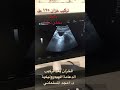 تركيب خزان الدعامة الهيدروليكية بشكل مخفي تمام د امجد المسلماني تركيب خزان الدعامة الهيدروليكية بشكل مخفي تمام د امجد المسلماني
