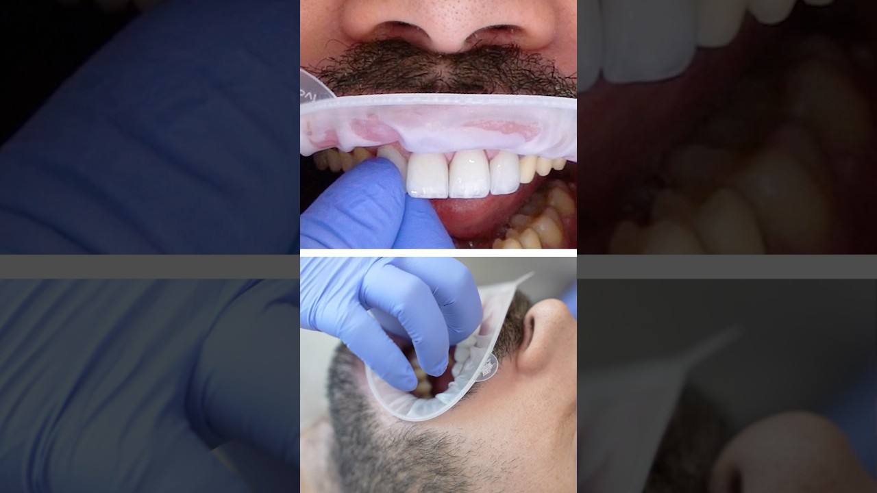 Veneer Procedure: A Complete Smile Transformation