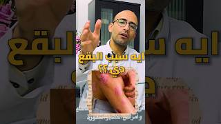 ما هو سبب الصدفية الجلدية ؟ دكتور_ايمن doctor_ayman الصدفية