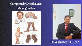 Campomelic Dysplasia As Micrognathia