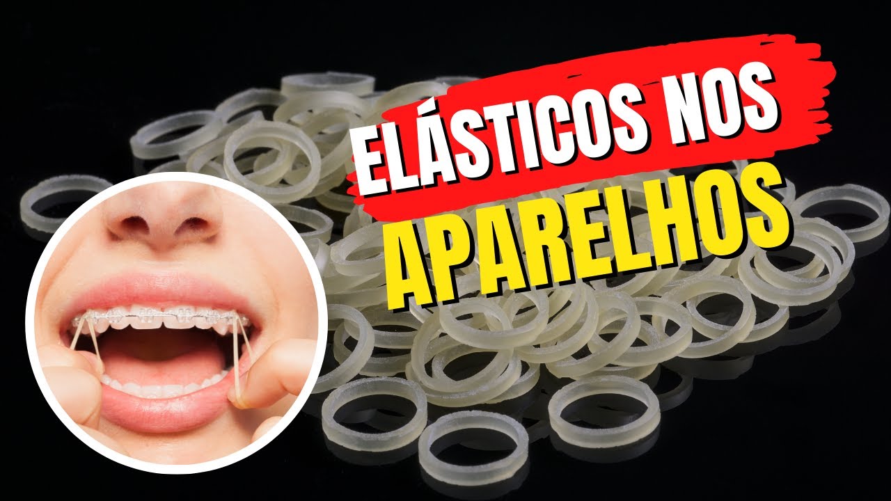 ELÁSTICO DO APARELHO ORTODÔNTICO | Quando e porque usar ?