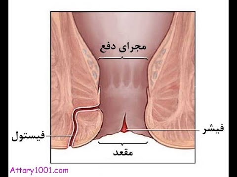 چند درمان خانگی و پیشگیری کننده ی یبوست -بواسیر وفیشر