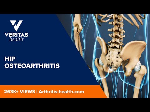 Hip Osteoarthritis