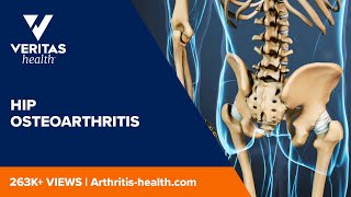 Hip Osteoarthritis