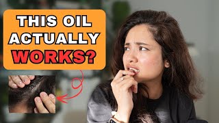 Treat Seborrheic Dermatitis Naturally with This One Oil