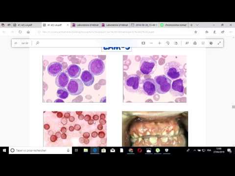 Vidéo: Comparaison In Silico De Deux Régimes D'induction (7 + 3 Vs 7 + 3 Plus évaluation Supplémentaire De La Moelle Osseuse) Dans Le Traitement De La Leucémie Myéloïde Aiguë