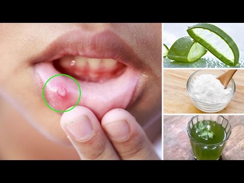 How to Get Rid of a Canker Sore Naturally at Home