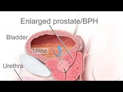 Video: Bartholin Körtel Abscess: Behandling, Kirurgi, Orsaker, Foto