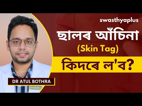 ছালৰ আঁচিনা: কাৰণ আৰু চিকিৎসা | What is Skin Tag? Assamese | Symptoms & Treatment | Dr Atul Bothra