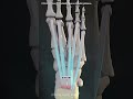 Plantar fascia release surgery #aesthetic #sad #rain