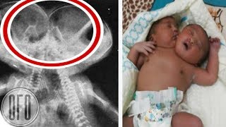Эти Сиамские Близняшки Видят Друг Друга Лишь В Зеркале 18 Лет Спустя Врачи в Недоумении Эти Сиамские Близняшки Видят Друг Друга Лишь В Зеркале 18 Лет Спустя Врачи в Недоумении
