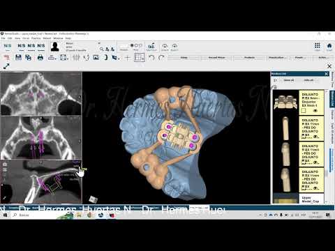 MARPE 3d EX