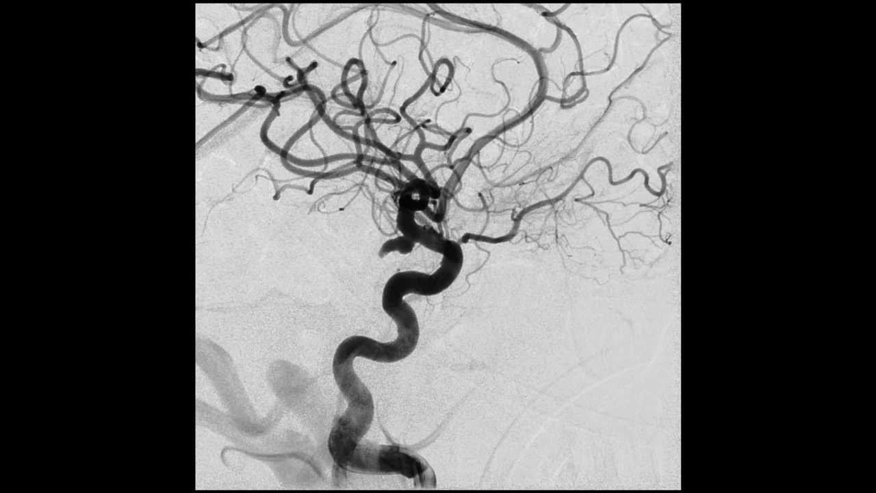 Ангиографическая эмболизация. Эмболизация сосудов головного мозга. Эмболизация мальформации. Эндоваскулярная спиральная эмболизация. Эндоваскулярная эмболизация аневризмы головного мозга.