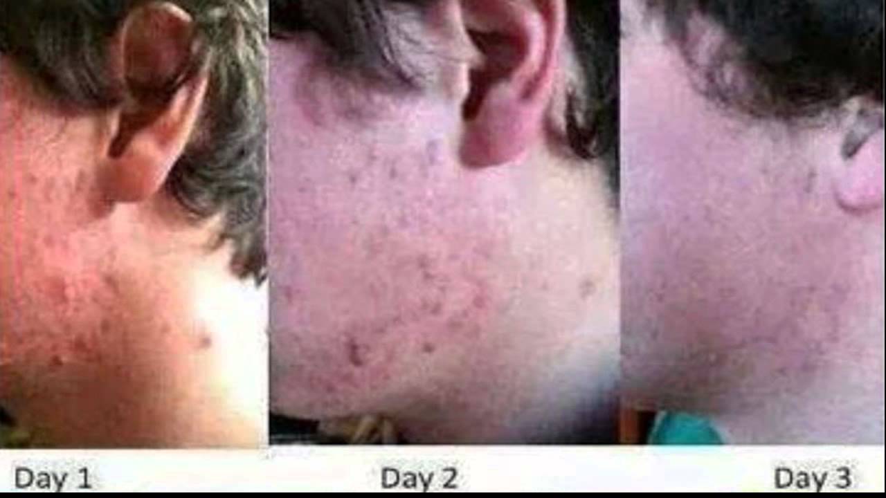 RENU 28 FREE Sample Acne