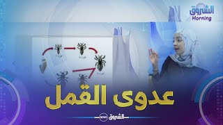 الشروق مورنينغ| القمل.. العدوى و الأسباب، طرق التخلص منه و الوقاية