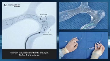 FRED Avoiding Compression Over the Aneurysm MV App