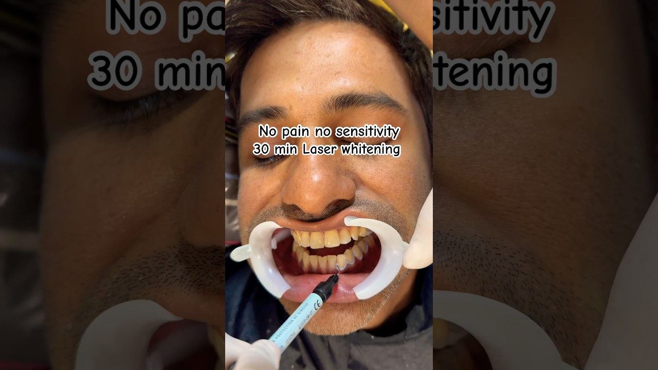 ‼️OFFER‼️Laser whitening @5999/- all inclusive 