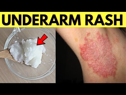 Try This Remedy To Heal Underarm Armpit Rash From Natural Deodorant