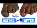 NuFeet Medical Pedicures® Transformation | Dead Nail Removal | Callus Exfoliation | Real Results