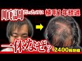 【衝撃の悲劇】植毛して1年経過したのにまさかの薄毛に逆戻り!?
