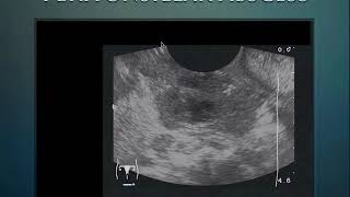 Ultrasound session for Fever Evaluation/ must see/very imp/multi system screenshot 2