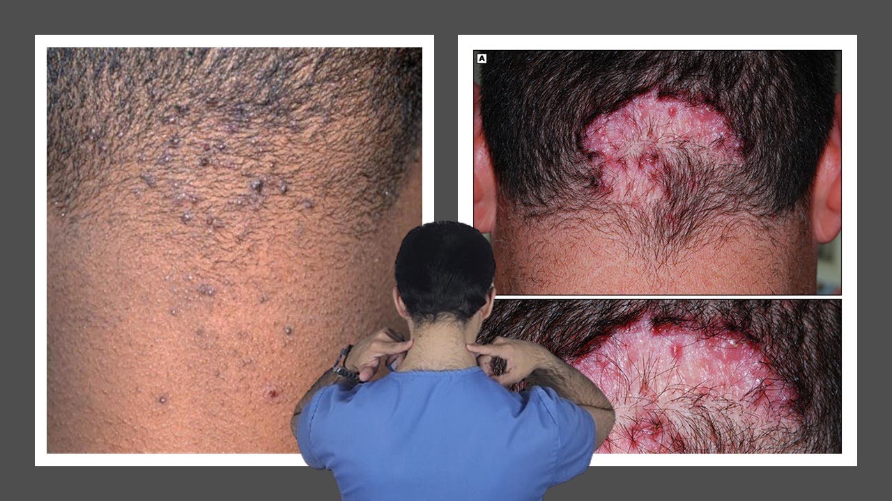 حبوب في مؤخرة الرأس - حب الشباب الجدري العنقي