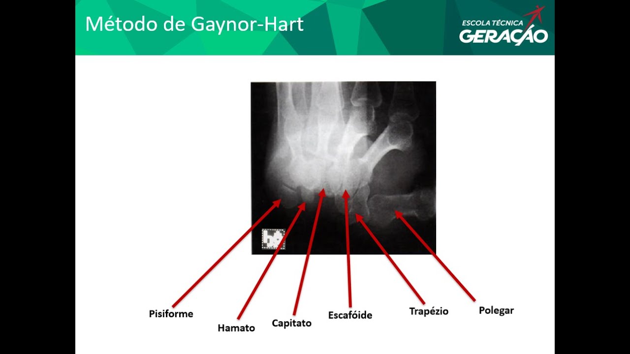 Radiografia do Punho método de Gaynor Hart (Túnel do Carpo) YouTube