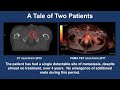 Oligometastatic Disease - 2021 Prostate Cancer Patient Conference