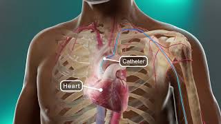 Cardiac Catheterization and Coronary Angiography | MSD Manual