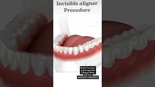 #Clear #aligners